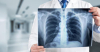 От 15 до 19 септември - безплатни прегледи за туберкулоза в МБАЛ „Св. Пантелеймон“ – Ямбол